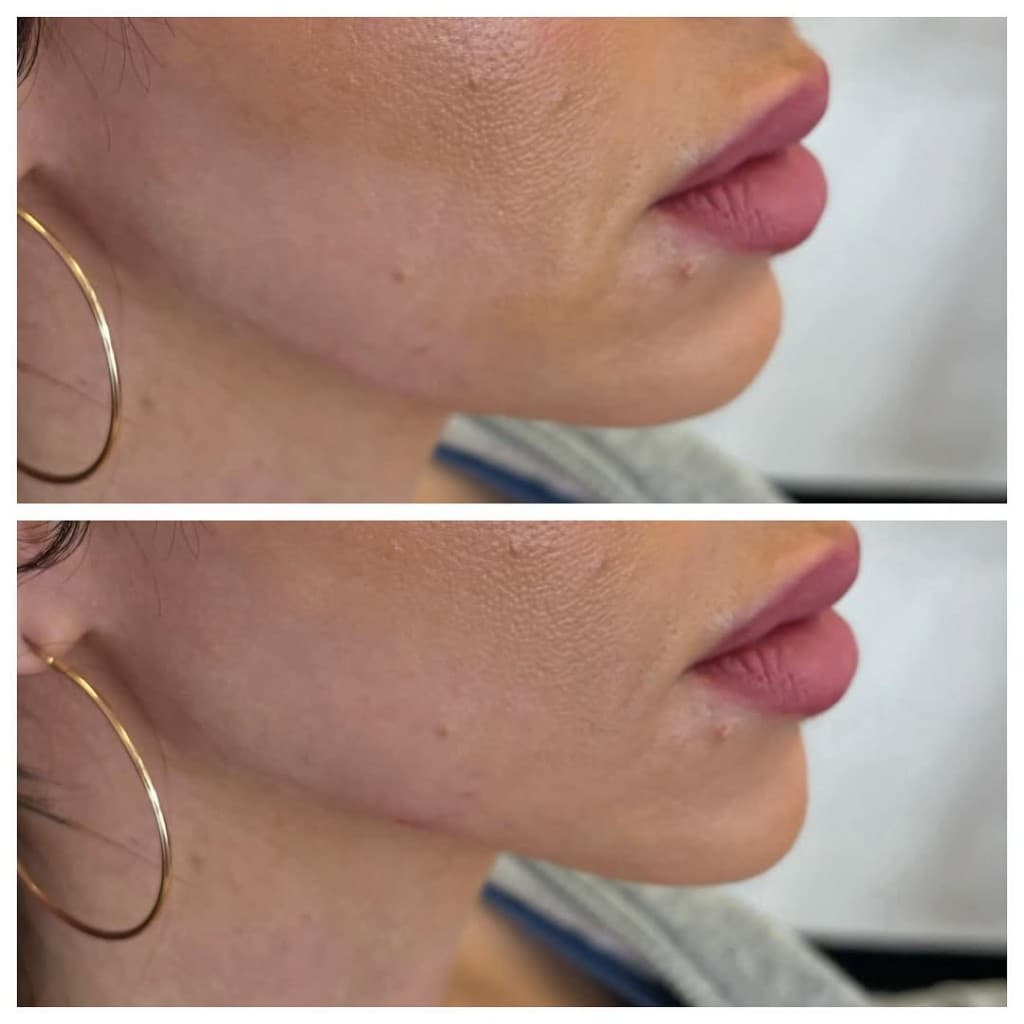Dermal Filler at Artful Aesthetic Medicine