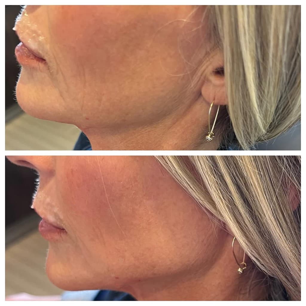 Dermal Filler at Artful Aesthetic Medicine, Englewood CO. Result 2.