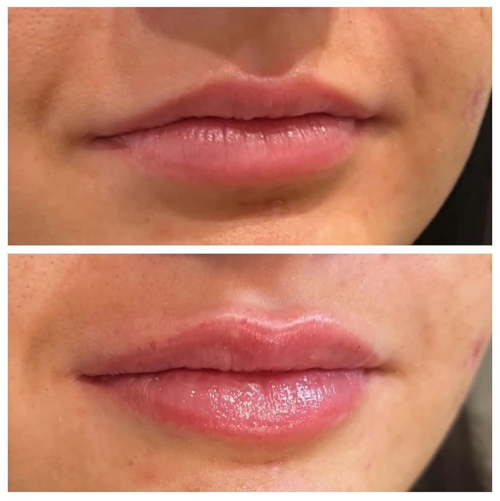 Lip Filler at Artful Aesthetic Medicine