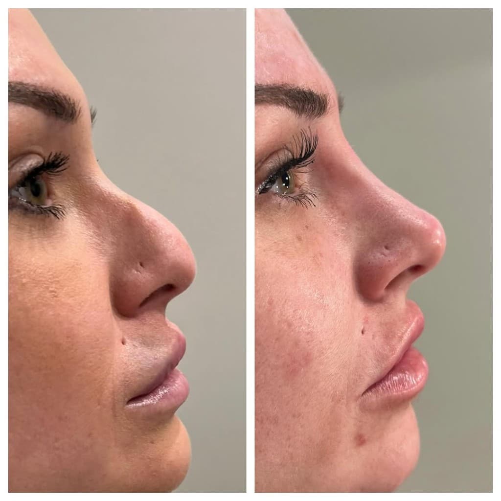 Non-Surgical Nose Job results