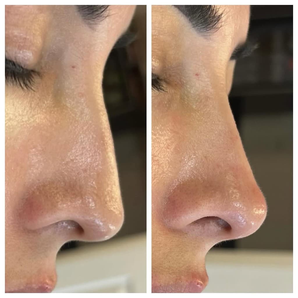 Non-Surgical Nose Job at Artful Aesthetic Medicine, Englewood CO. Result 2.